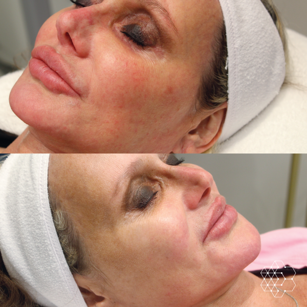 Forever Young BBL™