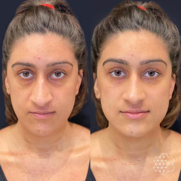 TiredEye™ Treatment