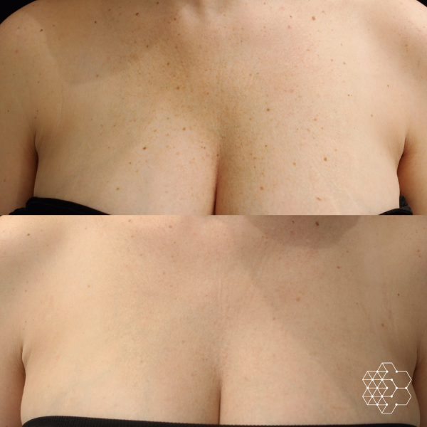 Forever Young BBL™