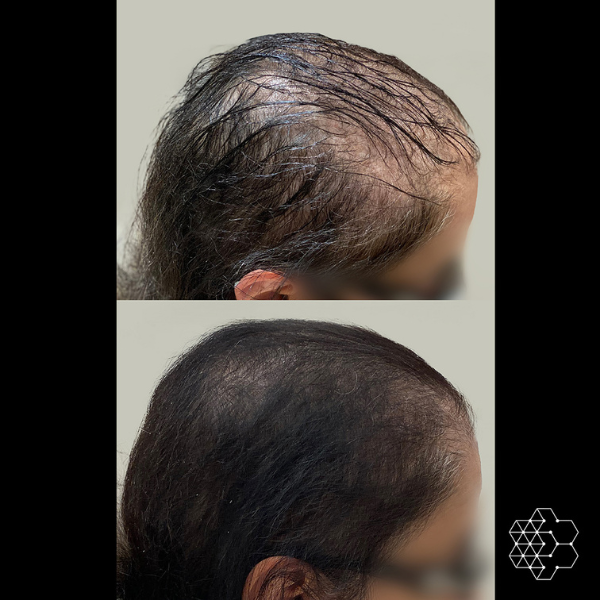 PRP Hair Restoration