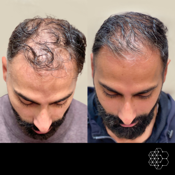 PRP Hair Restoration