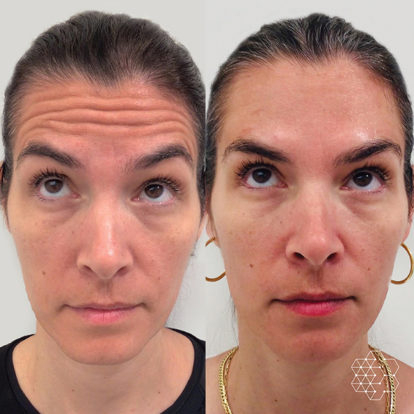 Forehead Lines Correction