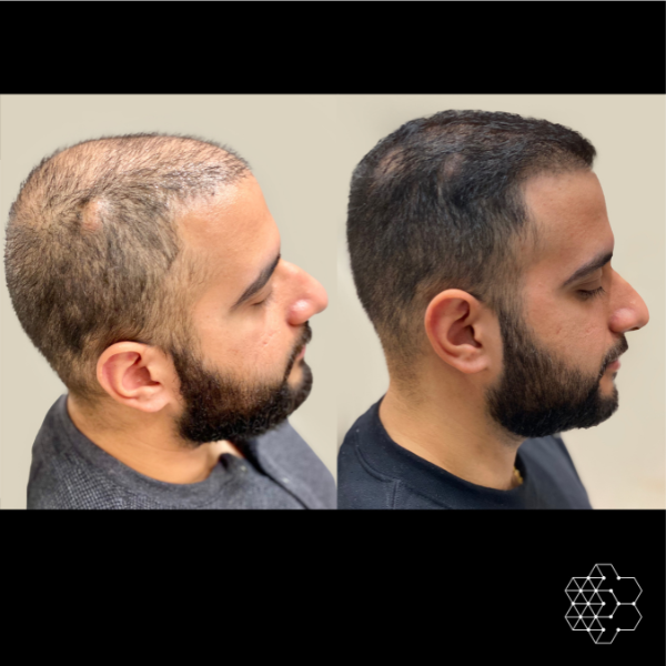 PRP Hair Restoration