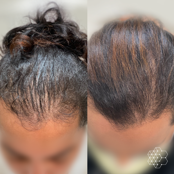 PRP Hair Restoration