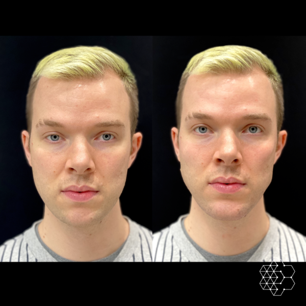 Jawline Masculinization