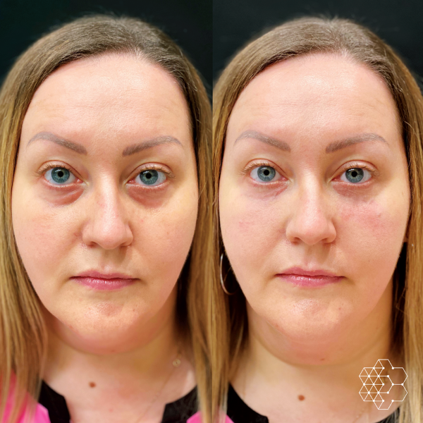 TiredEye™ Treatment