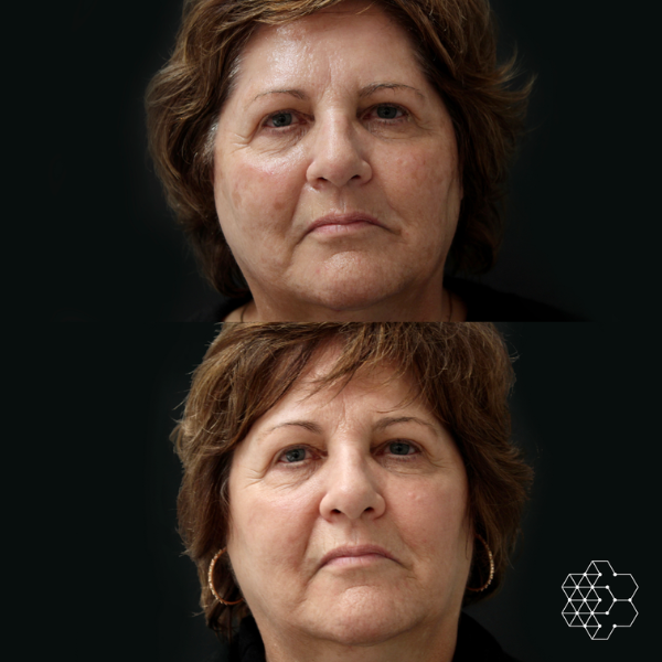 HALO™ Fractional Resurfacing