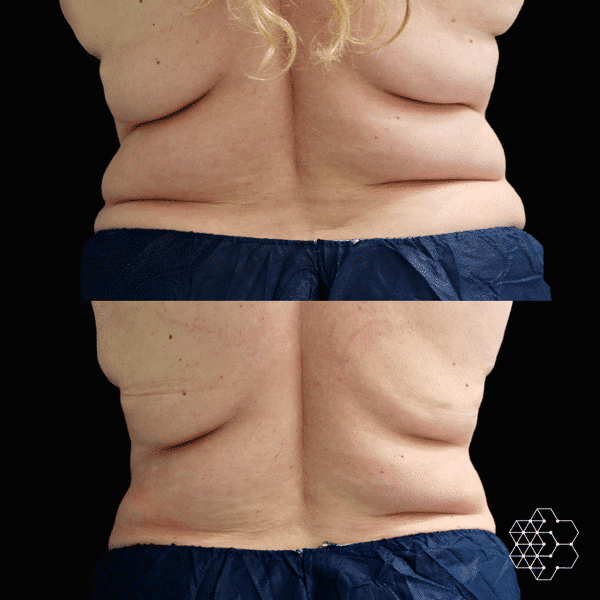 CoolSculpting
