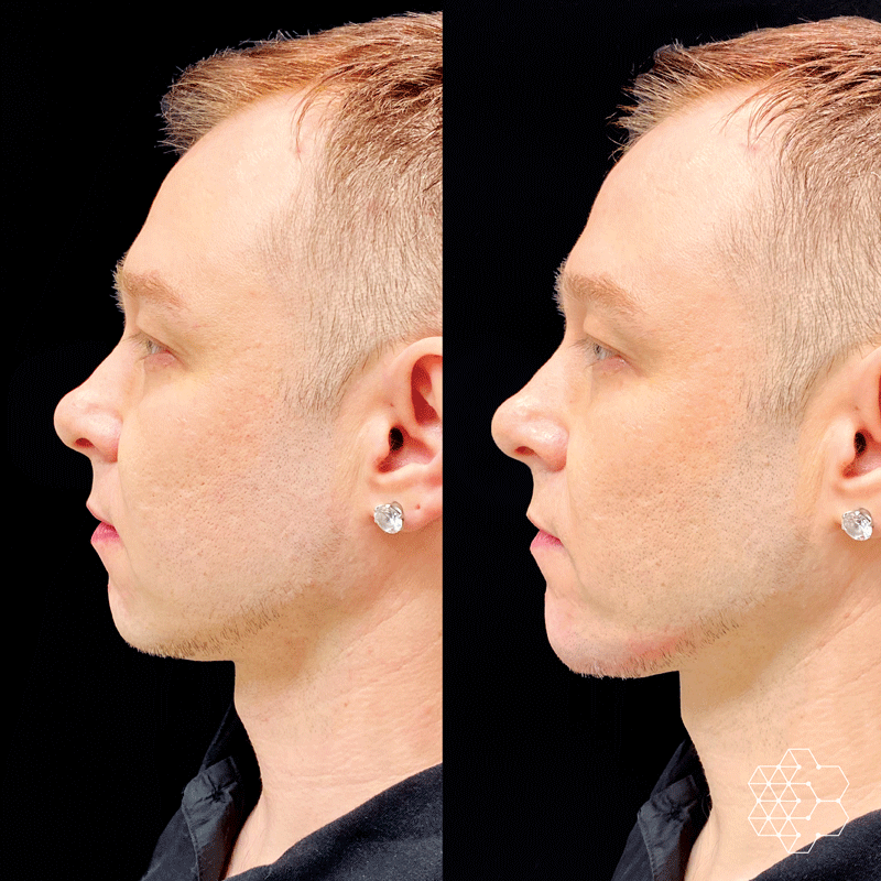 Jawline Masculinization