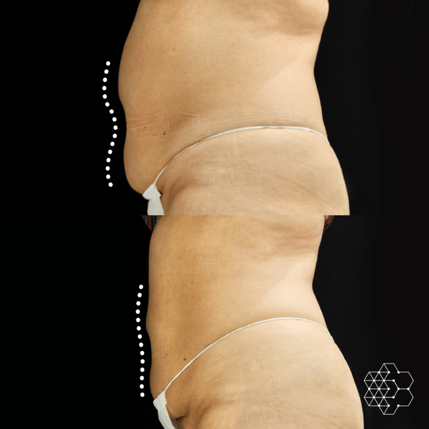 Coolsculpting Vs Sculpsure: Which Is Right for You?