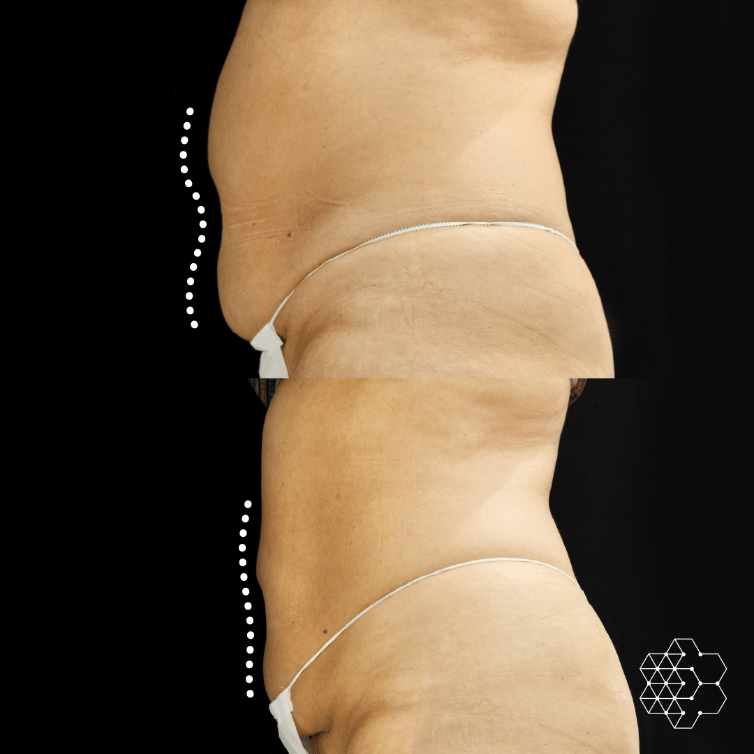 CoolSculpting Vs. Sculpsure: Which Is Right for You?