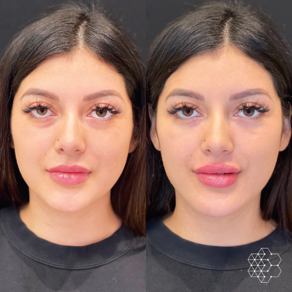 Lip Enhancement