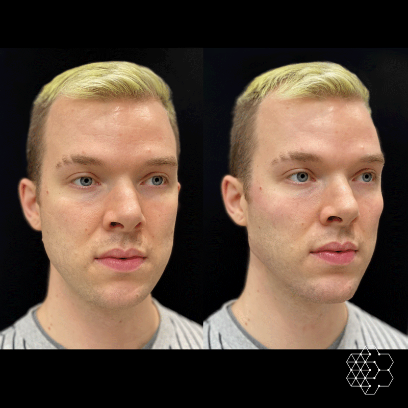 Jawline Masculinization