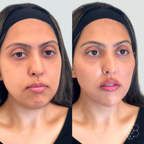 MystLift™ Beautification