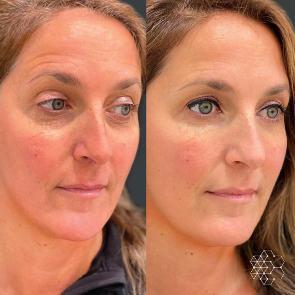 MystLift™ Beautification