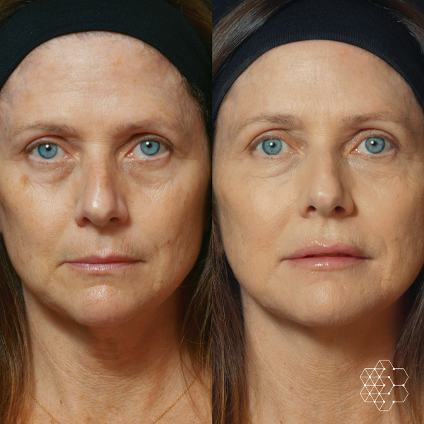 MystLift™ Beautification