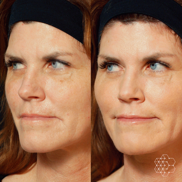 MystLift™ Beautification