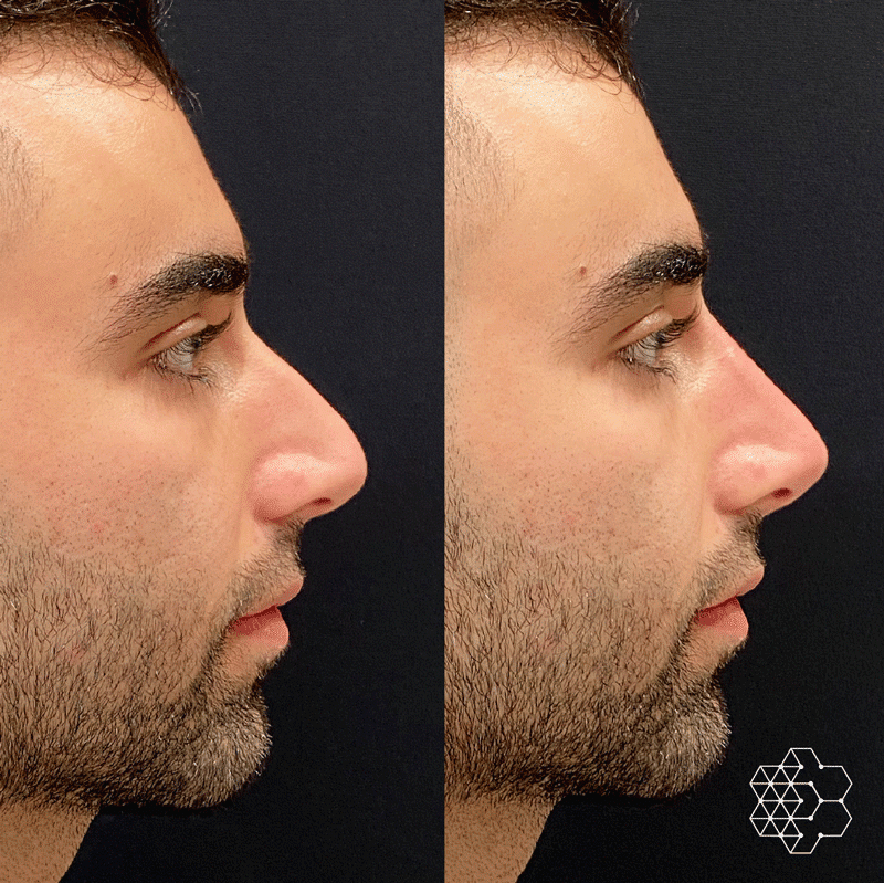 Non Surgical Nose Job