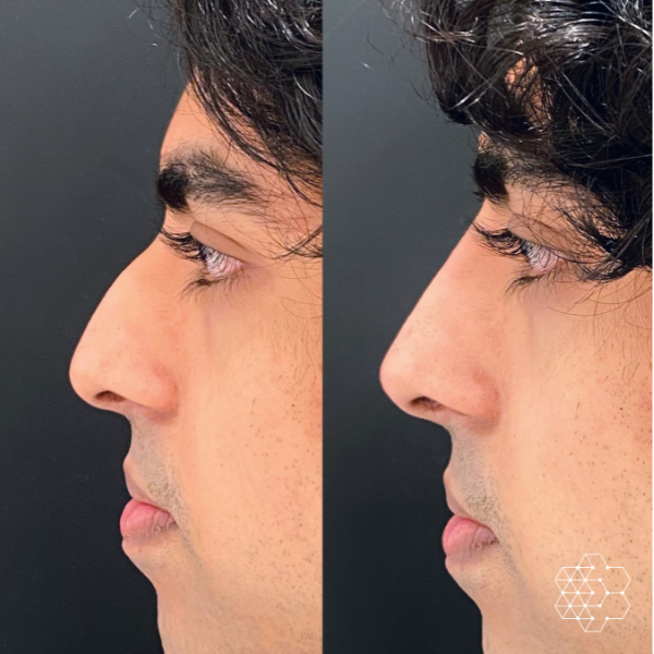 Non Surgical Nose Job