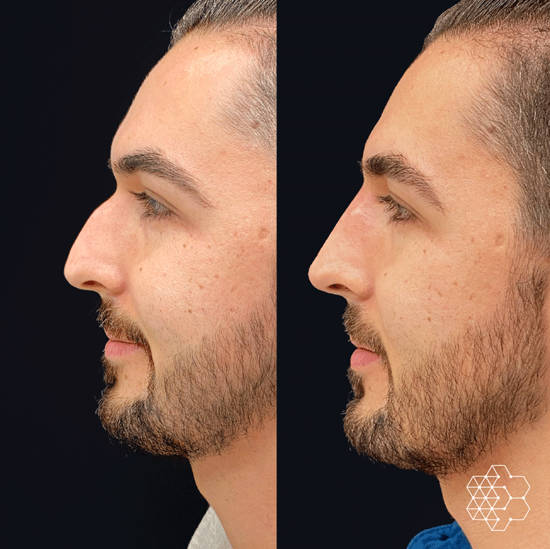 Non Surgical Nose Job