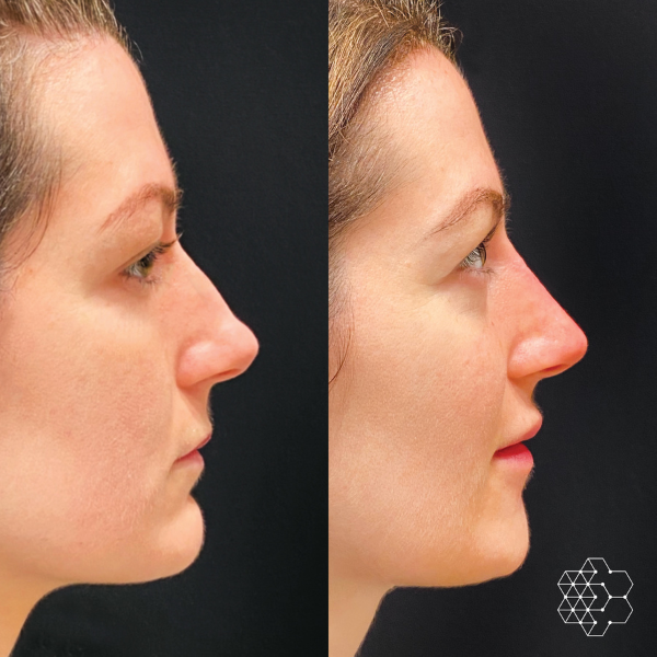 Non Surgical Nose Job