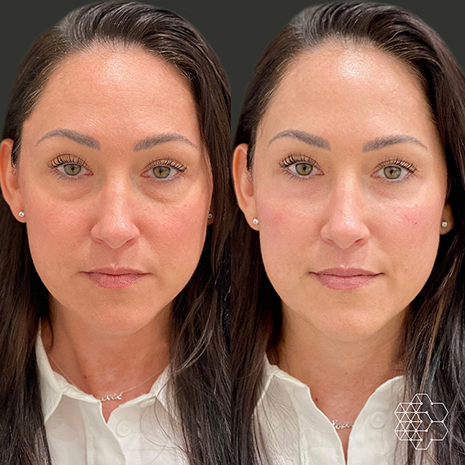 TiredEye™ Treatment