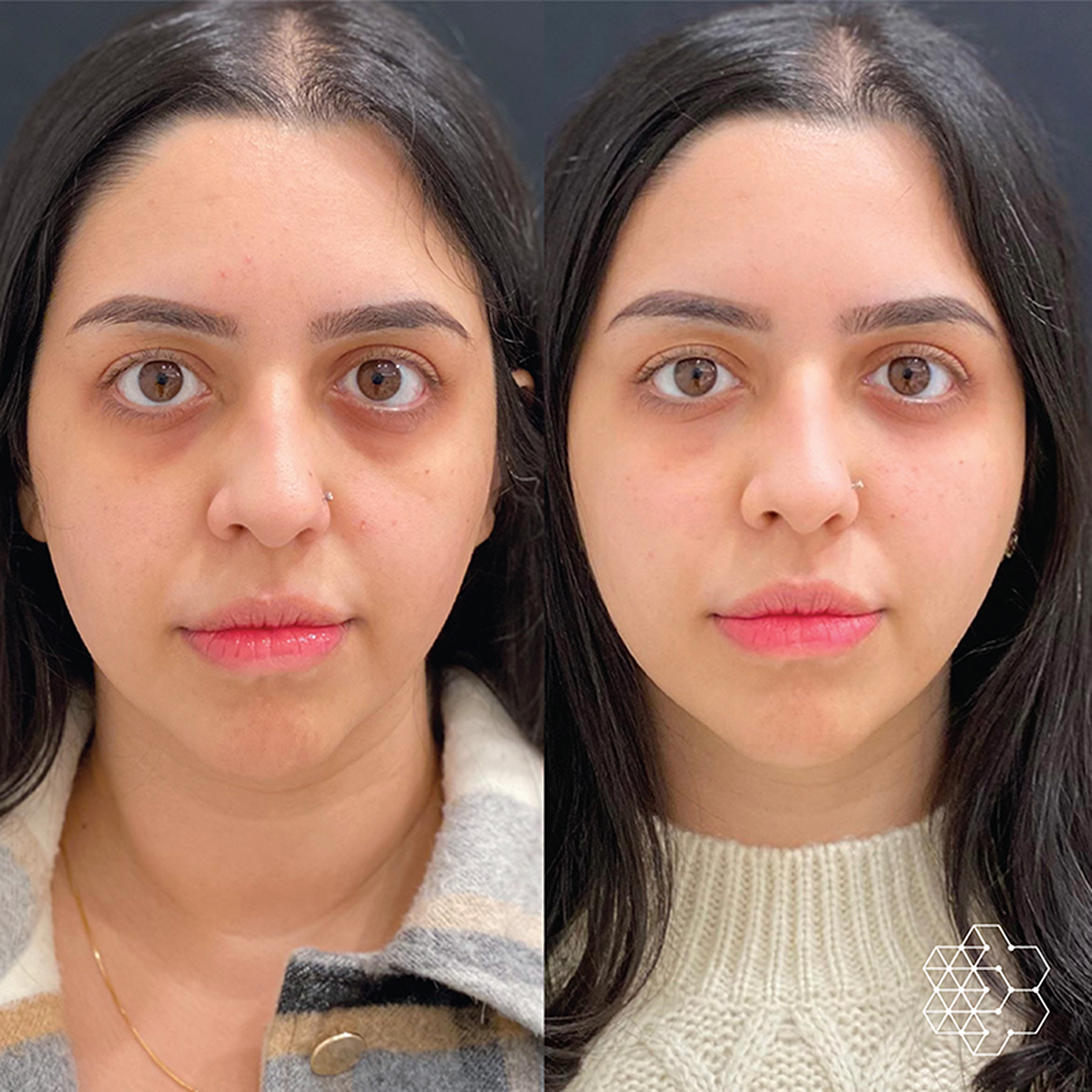 TiredEye™ Treatment