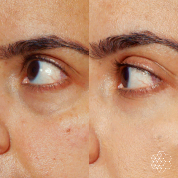 TiredEye™ Treatment