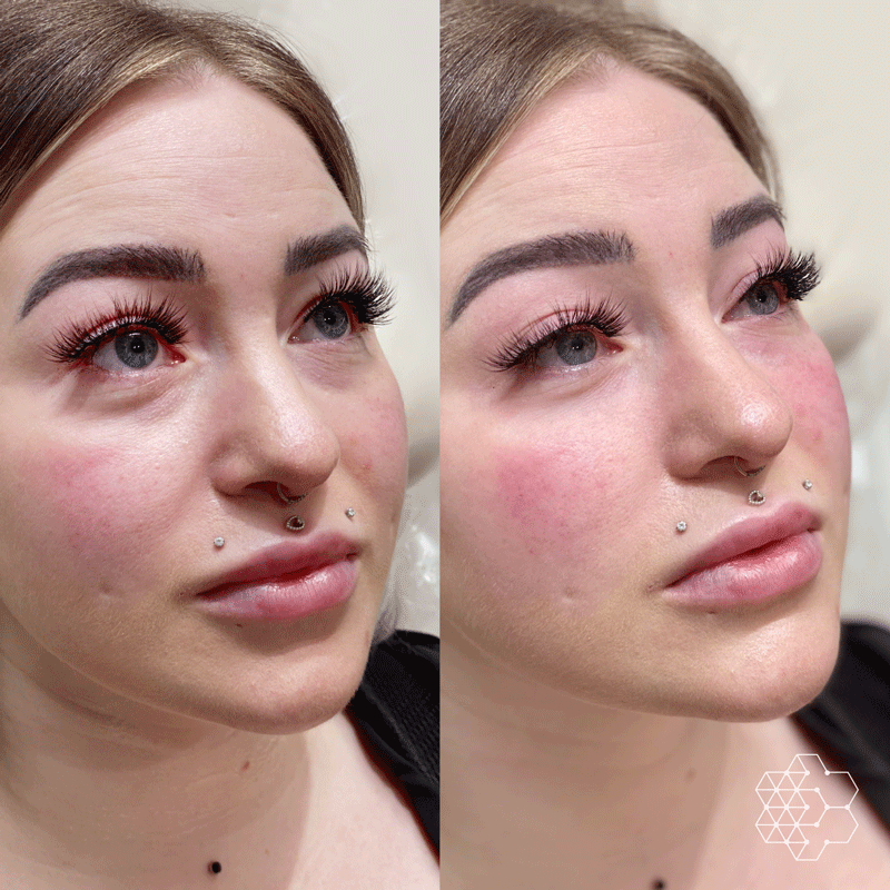 TiredEye™ Treatment